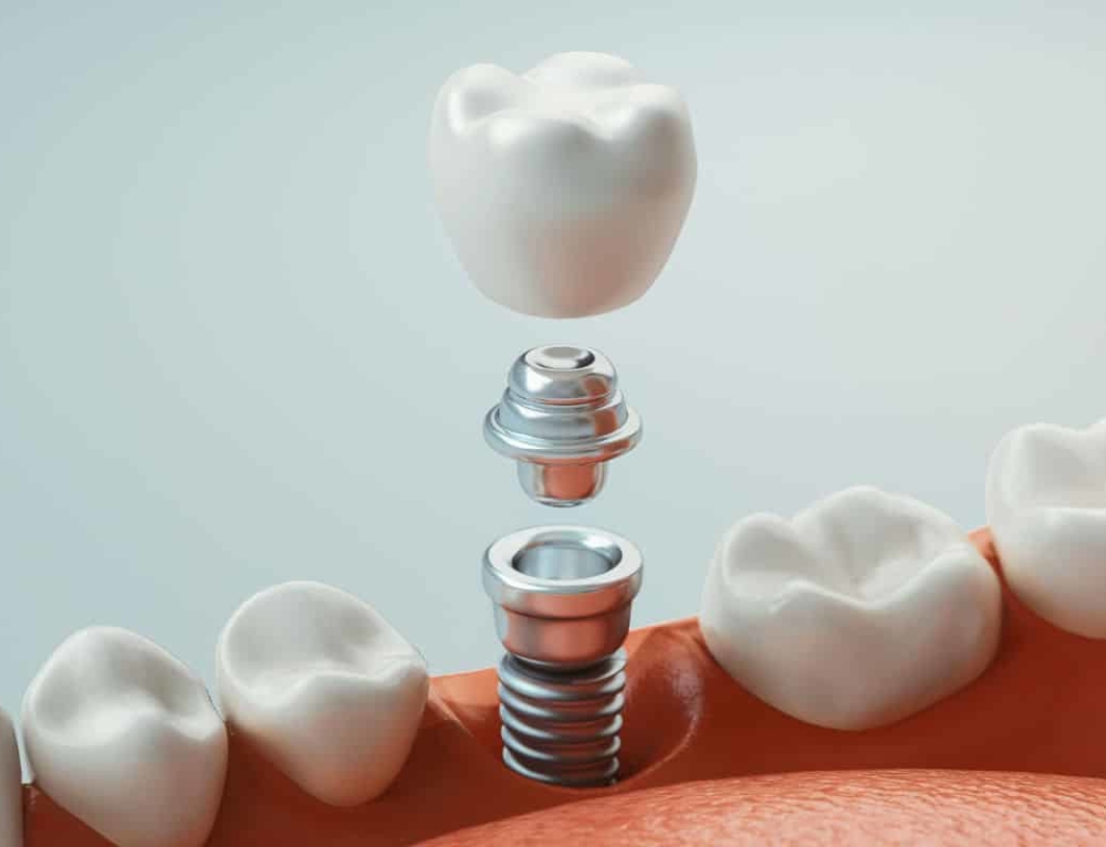 ¿Cómo es un implante dental y de qué partes se compone?